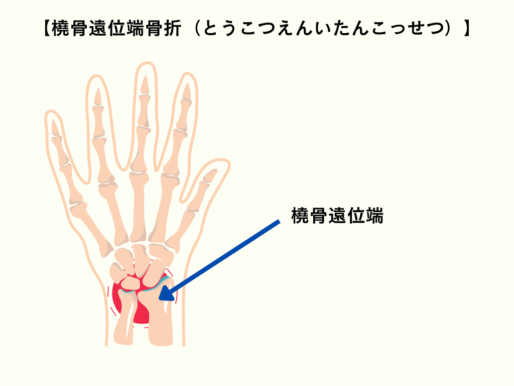 ④：転倒時に手をつくことで起こる「橈骨遠位端骨折」